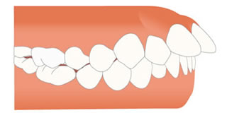 上顎前突（じょうがくぜんとつ）