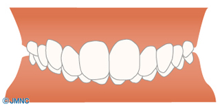 過蓋咬合（かがいこうごう）