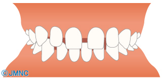 空隙歯列（くうげきしれつ）